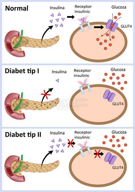 Diabet zaharat insulino-dependent și noninsulin
